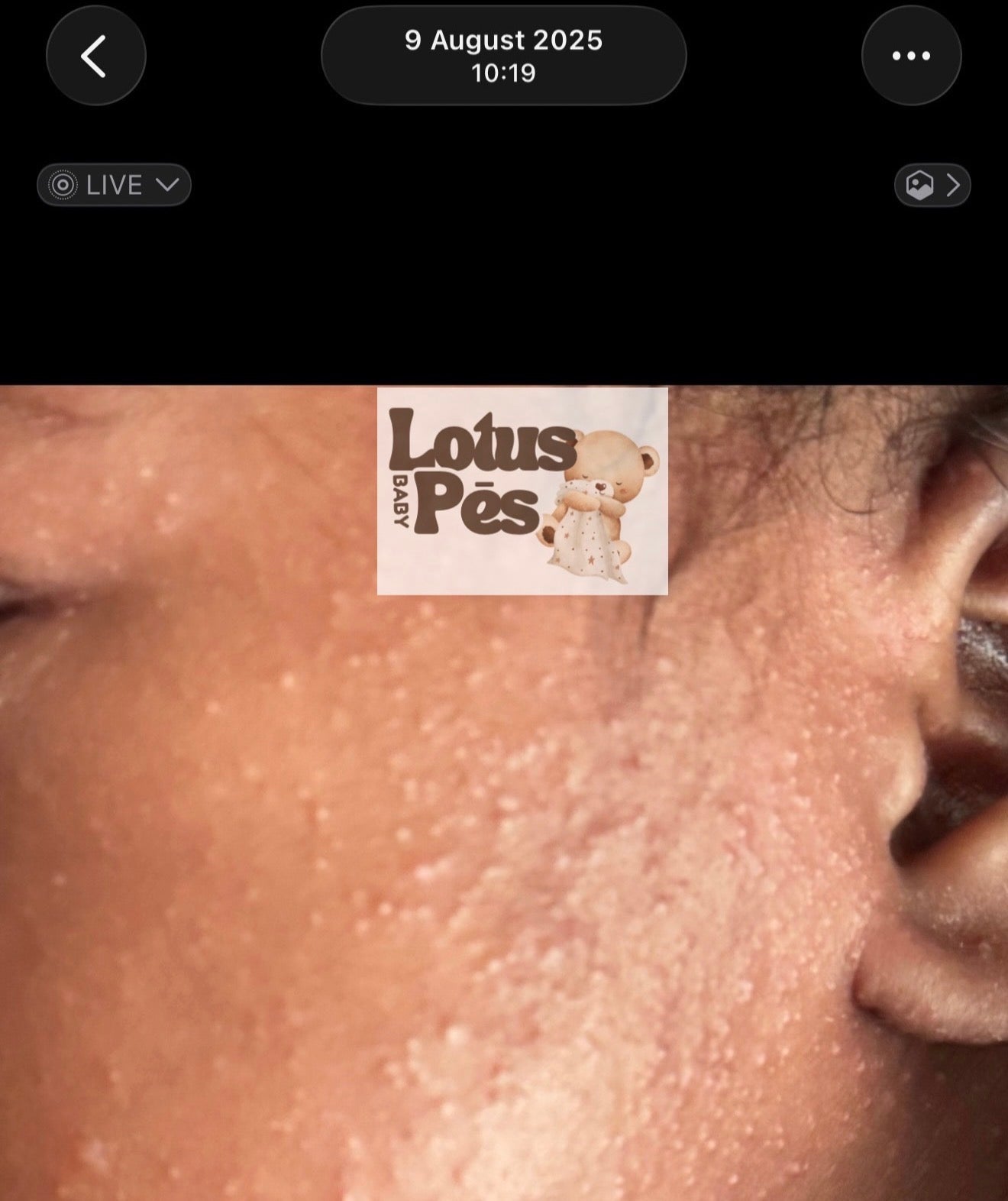 Before — irritated baby skin