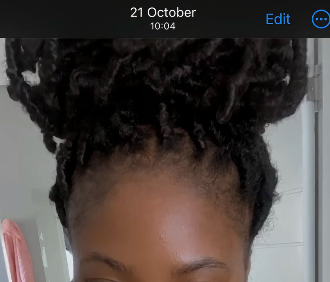 Before — thinning hairline