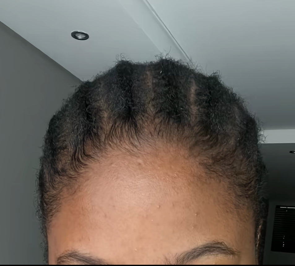 After — fuller hairline